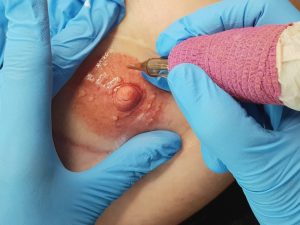 Become a Model for Areola Tattooing or Scar Camouflage