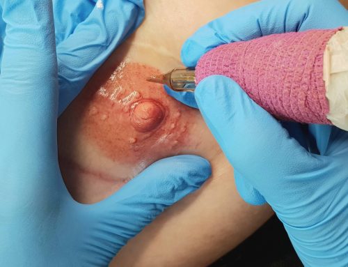Become a Model for Areola Tattooing or Scar Camouflage