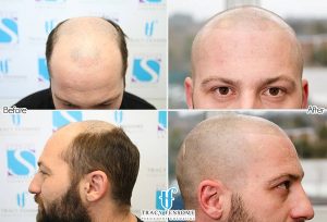 Scalp Micropigmentation