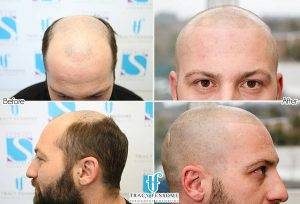 Scalp Micropigmentation Signature Academy